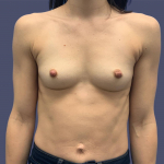 Breast Augmentation 29 Before